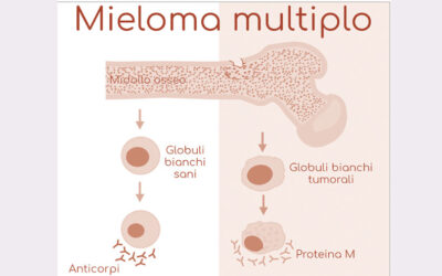 La leucemia mieloide acuta e l’importanza del microambiente del midollo osseo